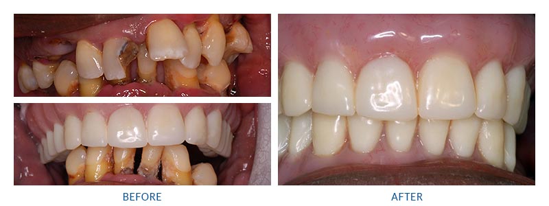 before and after