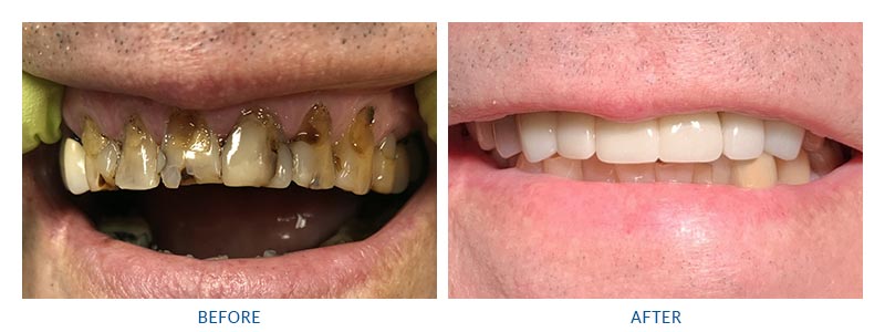 before and after dental crowns