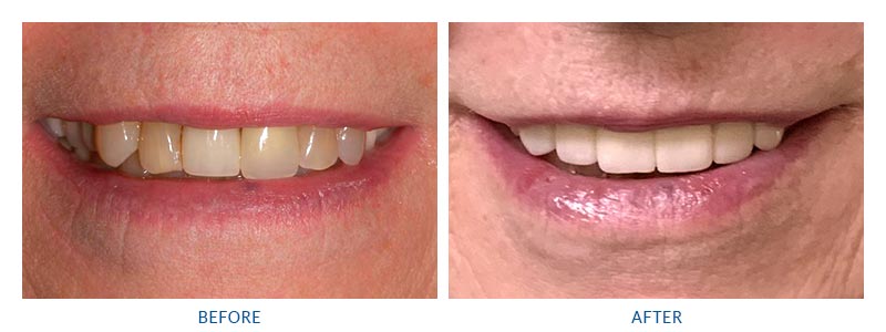 before and after dental crowns