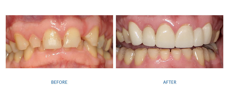 before and after dental crowns